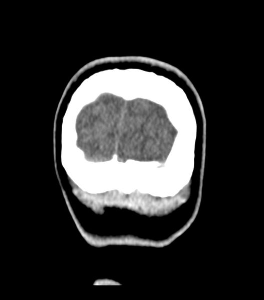 File:Choroid plexus carcinoma (Radiopaedia 91013-108552 Coronal non-contrast 82).jpg