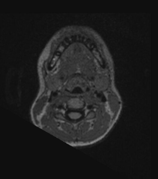 File:Choroid plexus carcinoma (Radiopaedia 91013-108553 Axial FLAIR C+ 22).jpg