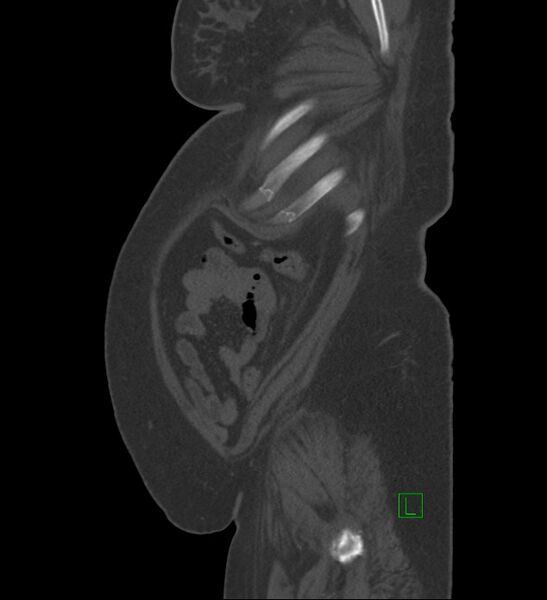 File:Chromophobe renal cell carcinoma (Radiopaedia 84239-99519 Sagittal bone window 10).jpg