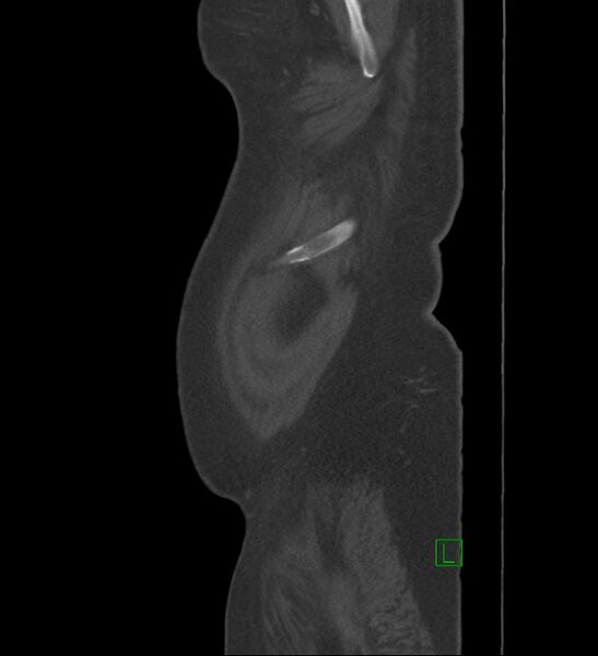 File:Chromophobe renal cell carcinoma (Radiopaedia 84239-99519 Sagittal bone window 103).jpg