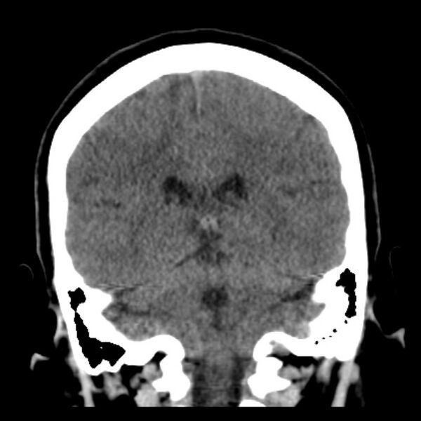 File:Chronic bilateral occipital lobe infarcts (Radiopaedia 31276-31996 Coronal non-contrast 32).jpg
