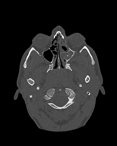 File:Chronic maxillary sinusitis caused by a foreign body (Radiopaedia 58521-65676 Axial bone window 165).jpg