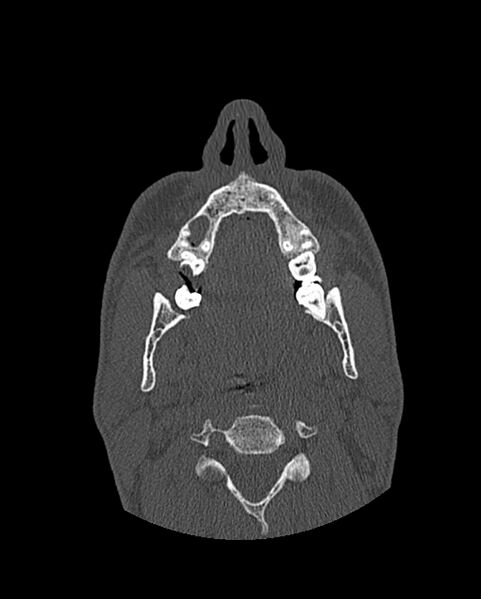 File:Chronic maxillary sinusitis caused by a foreign body (Radiopaedia 58521-65676 Axial bone window 34).jpg