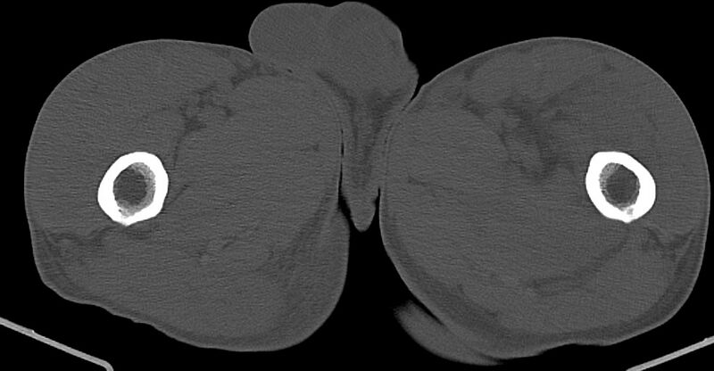 File:Chronic osteomyelitis (with sequestrum) (Radiopaedia 74813-85822 Axial non-contrast 66).jpg