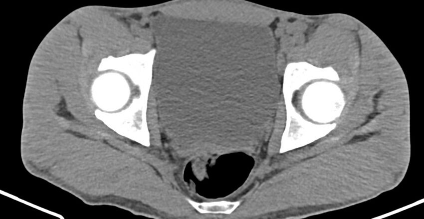 Chronic osteomyelitis (with sequestrum) (Radiopaedia 74813-85822 D 32).jpg