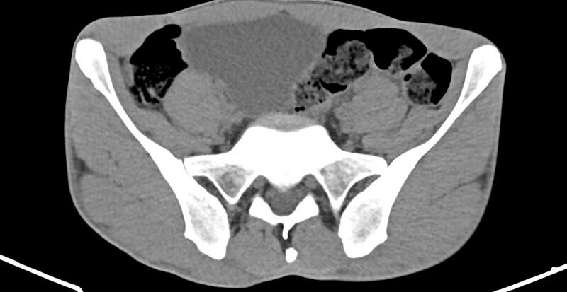 File:Chronic osteomyelitis (with sequestrum) (Radiopaedia 74813-85822 D 4).jpg