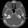 Chronic otomastoiditis (Radiopaedia 27138-27309 Axial bone window 33).jpg