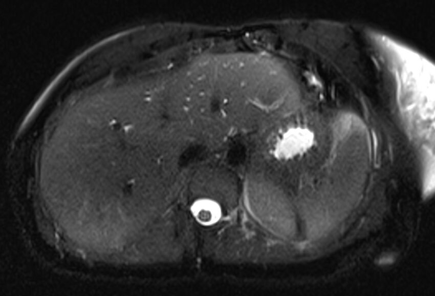 Chronic pancreatitis - pancreatic duct calculi (Radiopaedia 71818-82250 Axial T2 fat sat 14).jpg
