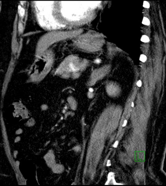 File:Clear cell renal cell carcinoma (Radiopaedia 85004-100537 D 25).jpg
