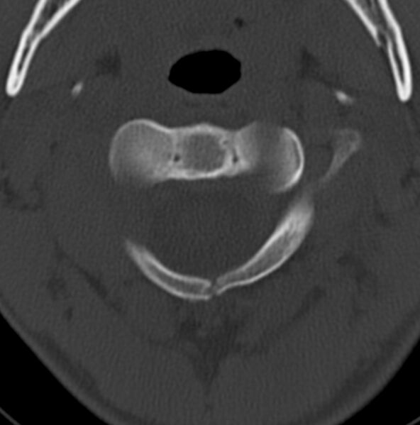 File:Cleft of the posterior arch of C1 mimicking fracture (Radiopaedia 40201-42721 Axial bone window 13).jpg