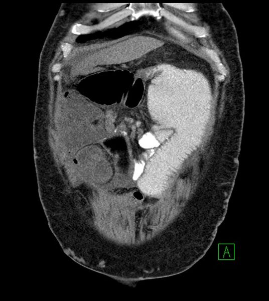 File:Closed-loop small bowel obstruction-internal hernia (Radiopaedia 78439-91096 Coronal non-contrast 25).jpg