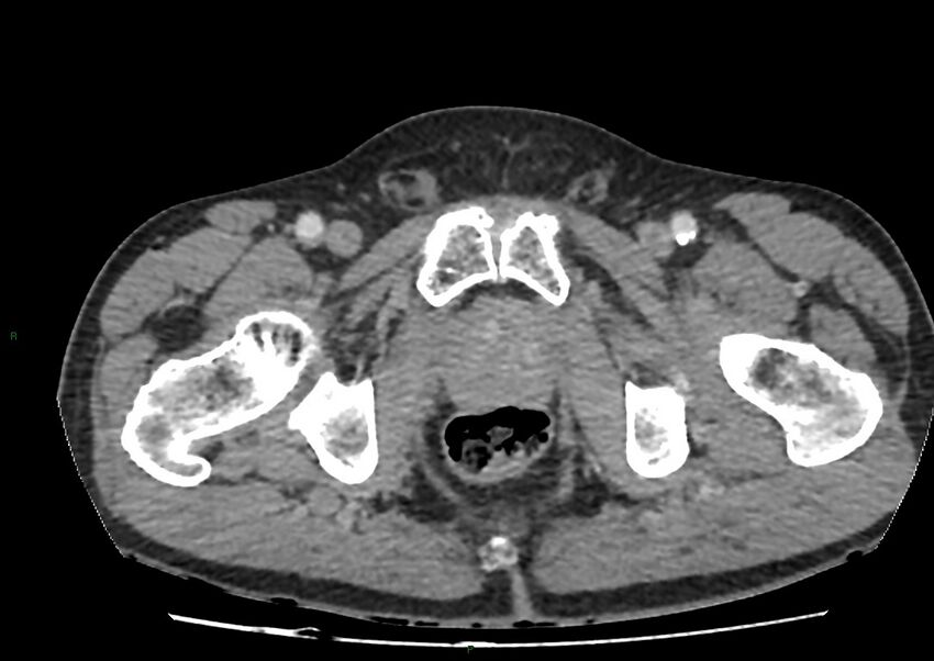 Closed loop small bowel obstruction with ischemia (Radiopaedia 84180-99456 A 121).jpg