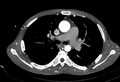 Coarctation of aorta with aortic valve stenosis (Radiopaedia 70463-80574 A 69).jpg