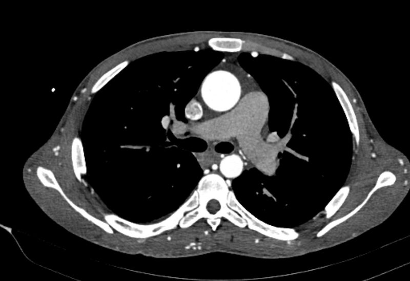 File:Coarctation of aorta with aortic valve stenosis (Radiopaedia 70463-80574 A 69).jpg