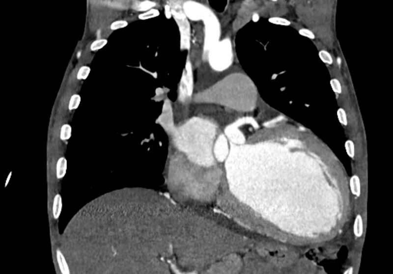 File:Coarctation of aorta with aortic valve stenosis (Radiopaedia 70463-80574 C 94).jpg