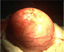 Leiomyoma. Intraoperative picture of uterus with large fibroid.
