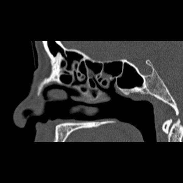 File:Nasal septal perforation (Radiopaedia 25030-25289 Sagittal bone window 36).jpg