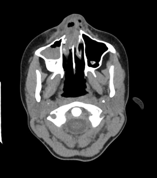 File:Nasoorbitoethmoid fracture (Radiopaedia 90044-107205 Axial non-contrast 113).jpg