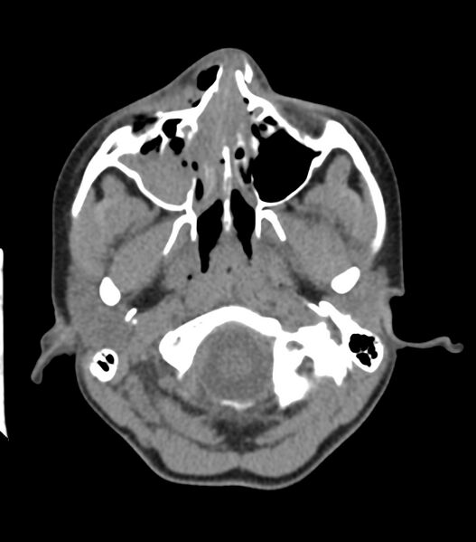 File:Nasoorbitoethmoid fracture (Radiopaedia 90044-107205 Axial non-contrast 132).jpg