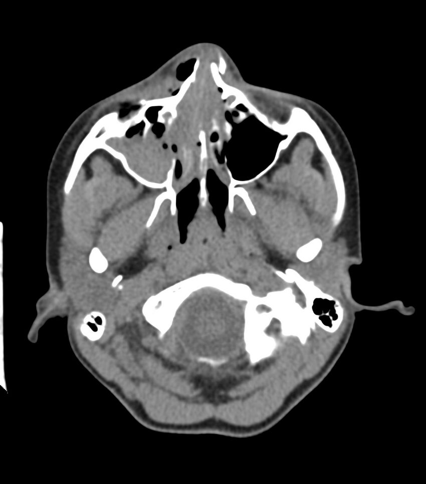 Nasoorbitoethmoid fracture (Radiopaedia 90044-107205 Axial non-contrast 132).jpg
