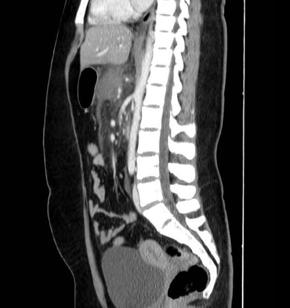 File:Necrotizing pancreatitis (Radiopaedia 23001-23031 C 40).jpg