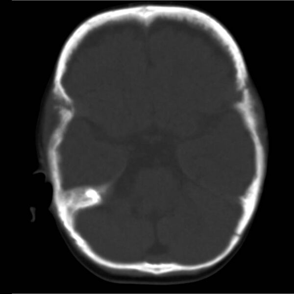 File:Neuroblastoma with skull metastases (Radiopaedia 30326-30958 Axial bone window 5).jpg