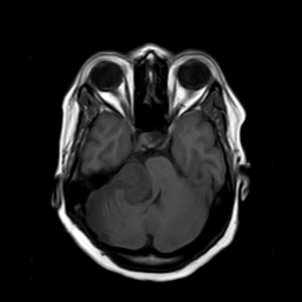 File:Neurofibromatosis type 2 (Radiopaedia 67470-76871 Axial T1 7).jpg
