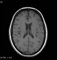 Neurosarcoidosis (Radiopaedia 10930-11351 Axial T1 12).jpg