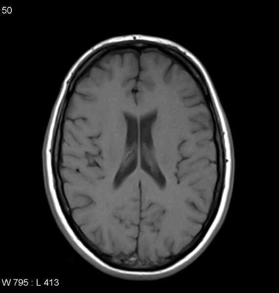 File:Neurosarcoidosis (Radiopaedia 10930-11351 Axial T1 12).jpg
