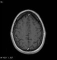 Neurosarcoidosis (Radiopaedia 10930-11351 Axial T1 C+ 16).jpg