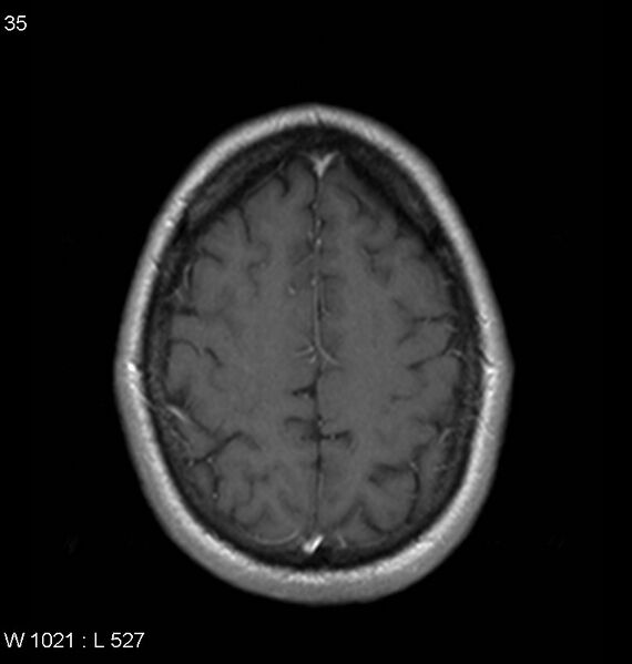 File:Neurosarcoidosis (Radiopaedia 10930-11351 Axial T1 C+ 16).jpg