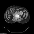 Non-Hodgkin lymphoma (Radiopaedia 27492-27690 B 5).jpg