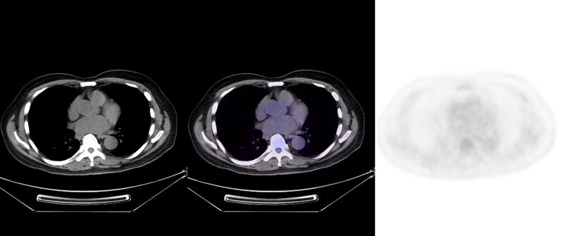 File:Non-Hodgkin lymphoma involving seminal vesicles with development of interstitial pneumonitis during Rituximab therapy (Radiopaedia 32703-33752 ax CT Fus PET 24).jpg
