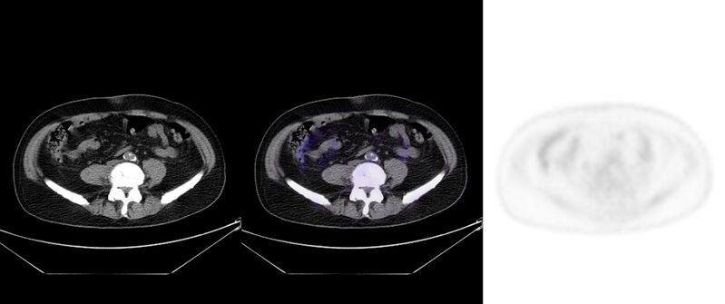 File:Non-Hodgkin lymphoma involving seminal vesicles with development of interstitial pneumonitis during Rituximab therapy (Radiopaedia 32703-33752 ax CT Fus PET 48).jpg