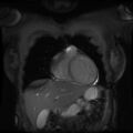 Non-compaction of the left ventricle (Radiopaedia 38868-41062 Coronal SSFP 2D FS 12).jpg