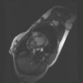 Non-compaction of the left ventricle (Radiopaedia 38868-41062 SAXs SSFP CINE 32).jpg