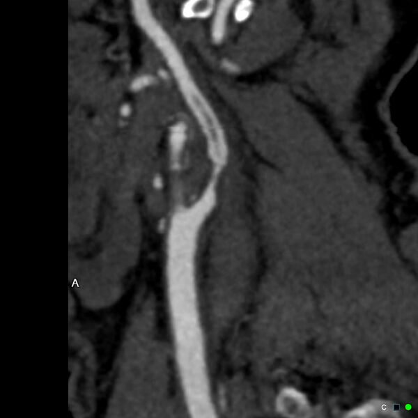 File:Non-occlusive intraluminal internal carotid artery thrombus (Radiopaedia 37751-39658 A 53).jpg