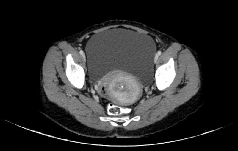 File:Non-puerperal uterine inversion (Radiopaedia 78343-91094 A 34).jpg