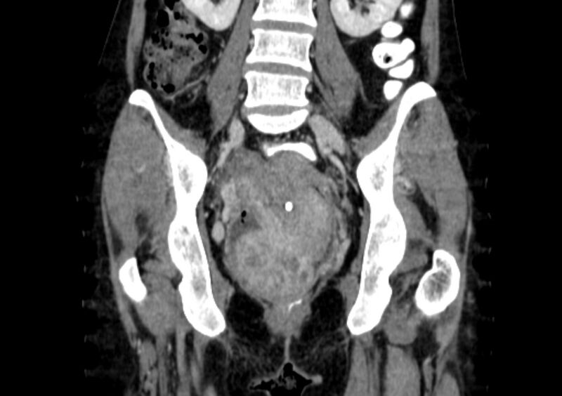 File:Non-puerperal uterine inversion (Radiopaedia 78343-91094 B 24).jpg