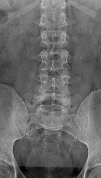 File:Normal AP lumbar spine (Radiopaedia 46401).jpg