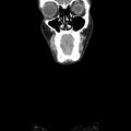 Normal CT of the neck (Radiopaedia 14575-14500 Coronal C+ 7).jpg