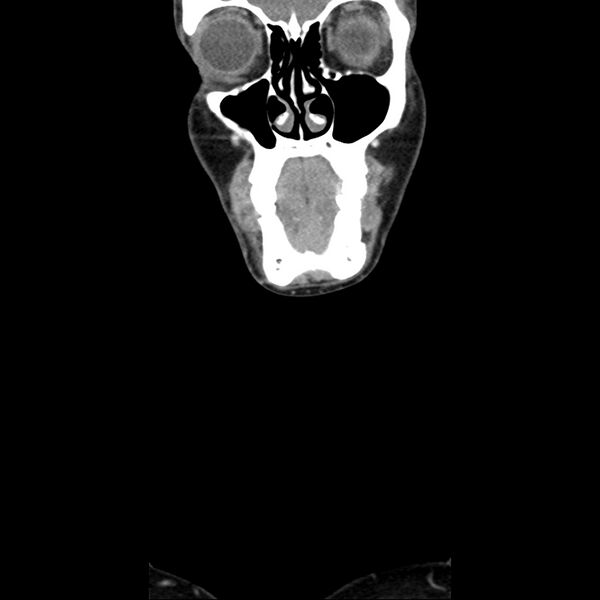 File:Normal CT of the neck (Radiopaedia 14575-14500 Coronal C+ 7).jpg
