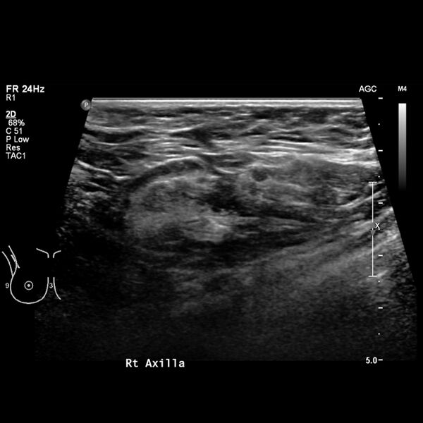 File:Normal breast mammography (tomosynthesis) and ultrasound (Radiopaedia 65325-74354 Right breast 16).jpeg