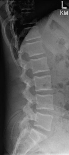 File:Normal lateral lumbar spine radiograph (Radiopaedia 46575).jpg