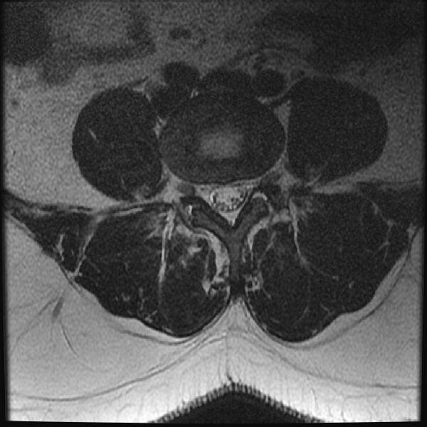 File:Normal lumbar spine MRI (Radiopaedia 43051-46311 Axial T2 17).jpg