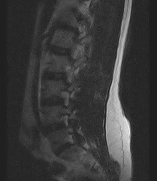 File:Normal lumbar spine MRI - low-field MRI scanner (Radiopaedia 40976-43699 Sagittal T2 3).jpg