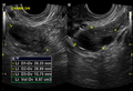 Normal pelvic ultrasound - transvaginal (Radiopaedia 31750-32684 G 1).png