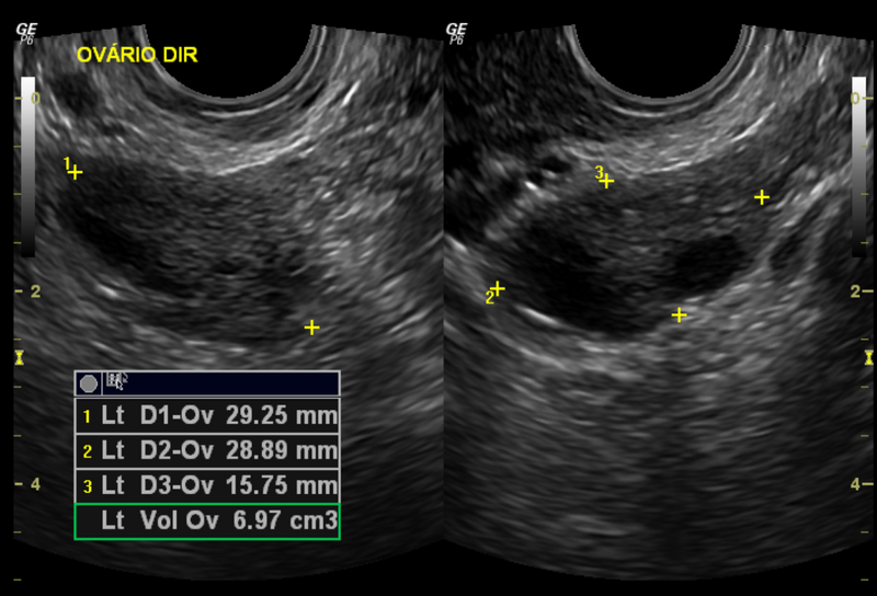 File:Normal pelvic ultrasound - transvaginal (Radiopaedia 31750-32684 G 1).png