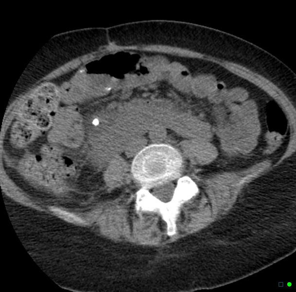 File:Obstructed infected horseshoe kidney (Radiopaedia 18116-17898 non-contrast 22).jpg