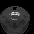 Occipital condyle fracture (Radiopaedia 31755-32691 Axial bone window 18).jpg